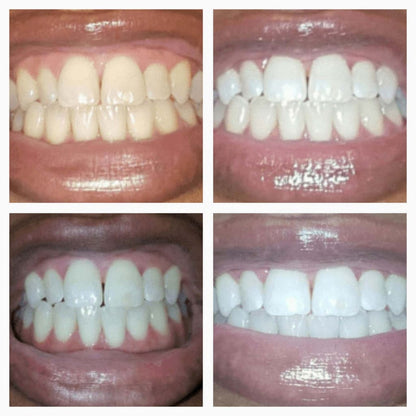 Extra-Strength Whitening Gold Serum Pen Dual-Peroxide Formula